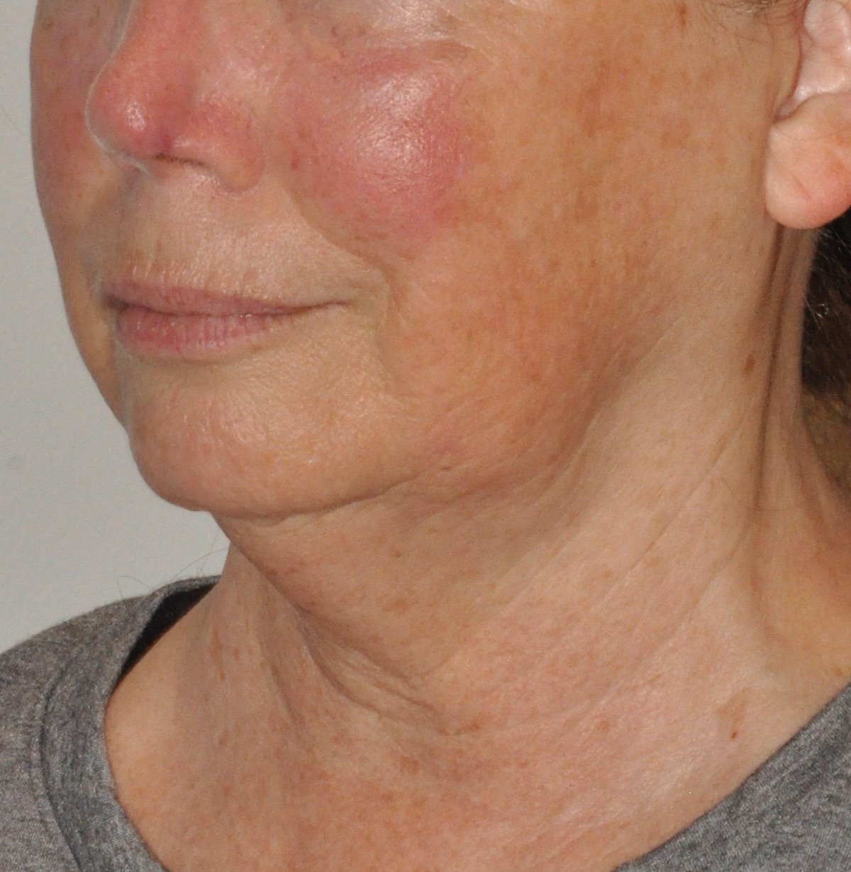 Face & Neck Lift