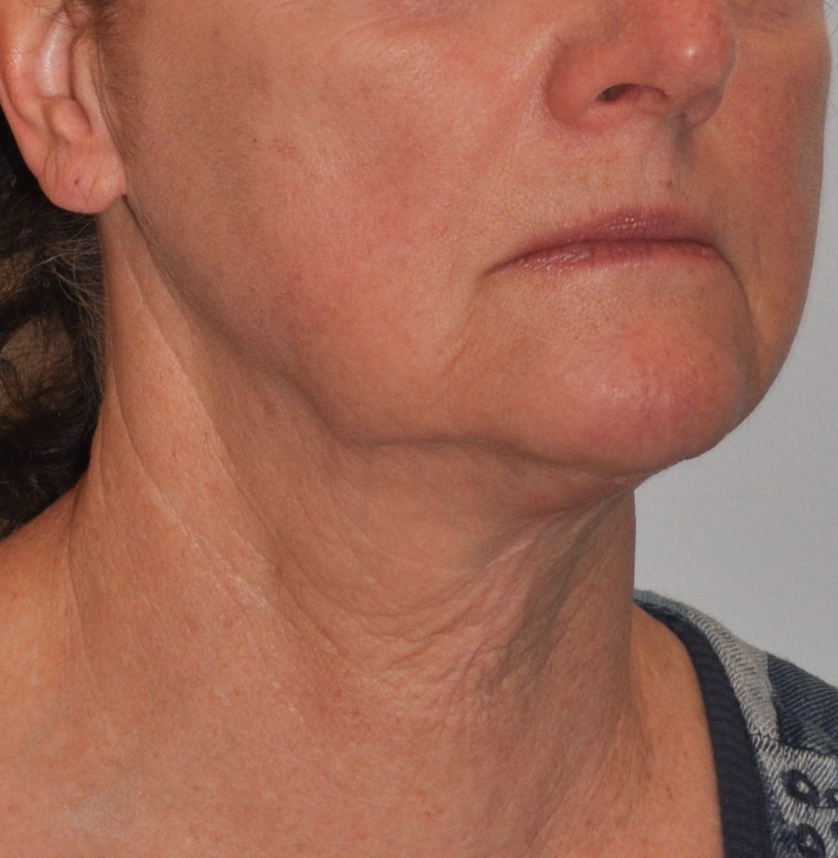 Face & Neck Lift