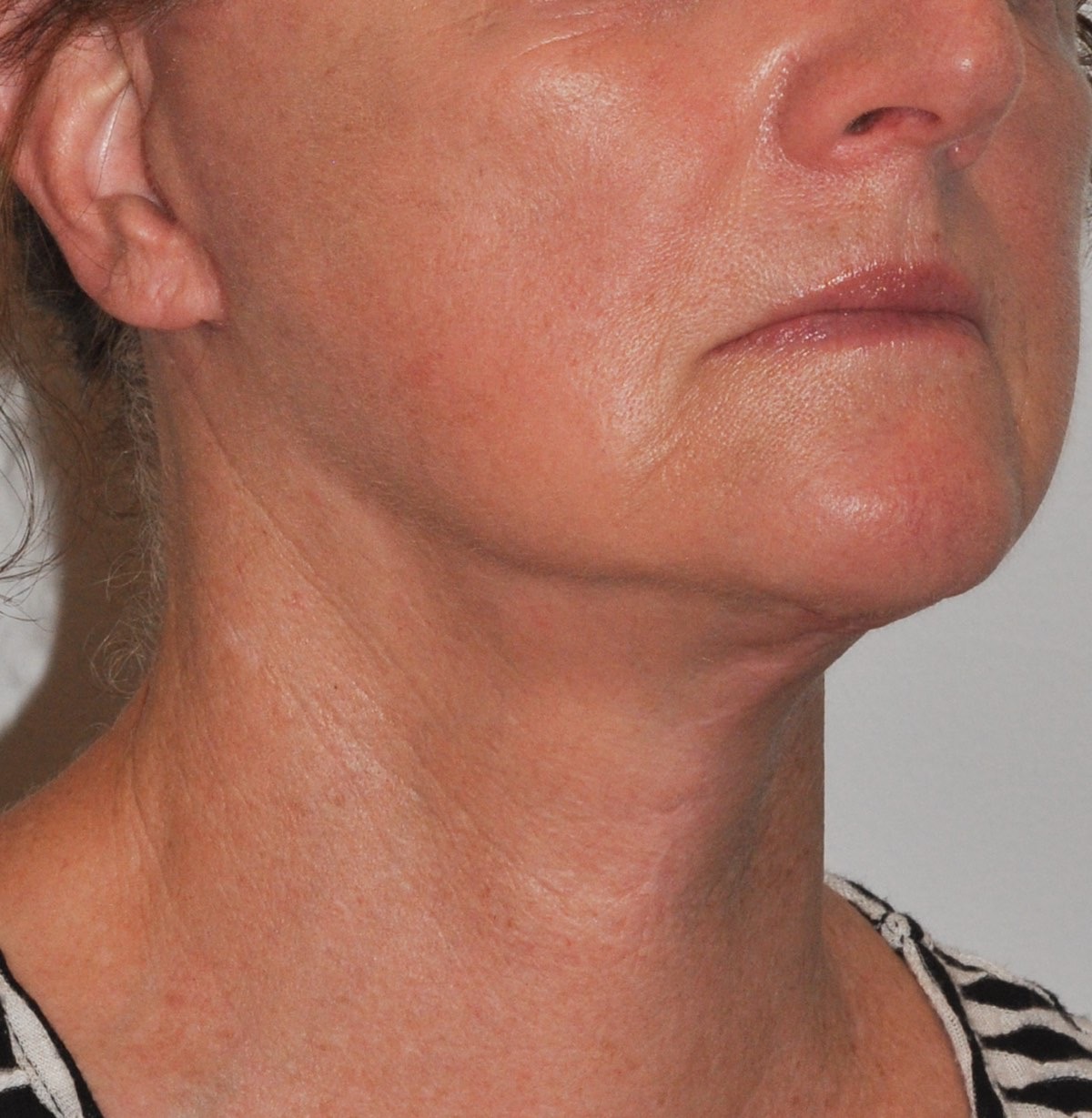 Face & Neck Lift