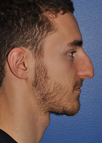 Rhinoplasty