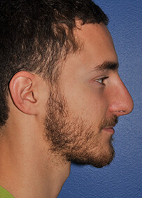 Rhinoplasty