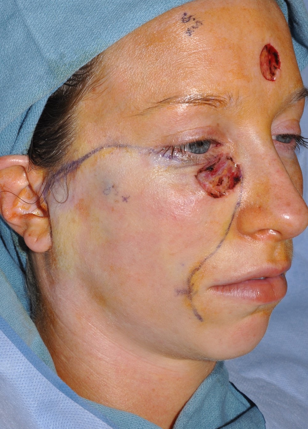 Eyelid & Cheek Reconstruction