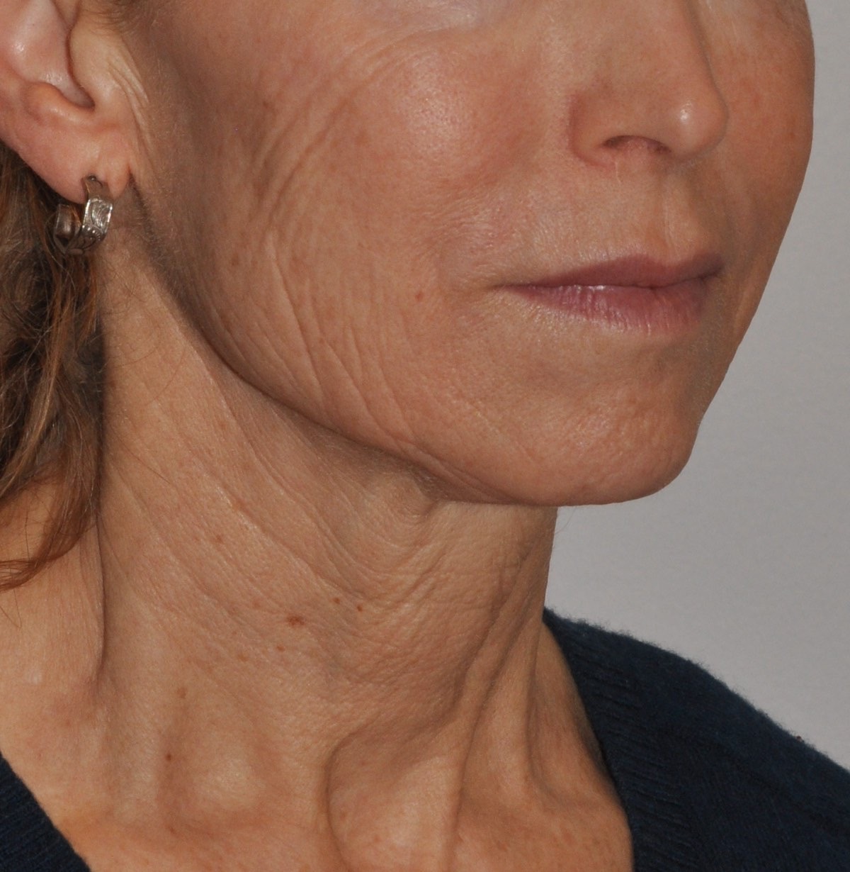 Face & Neck Lift