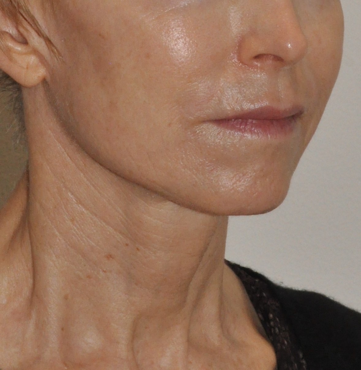 Face & Neck Lift