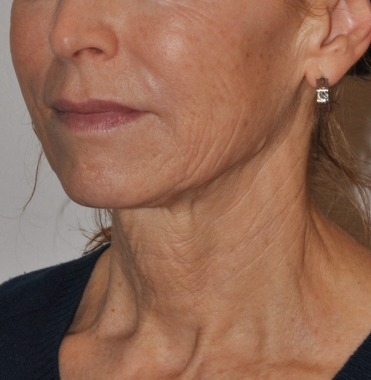 Face & Neck Lift