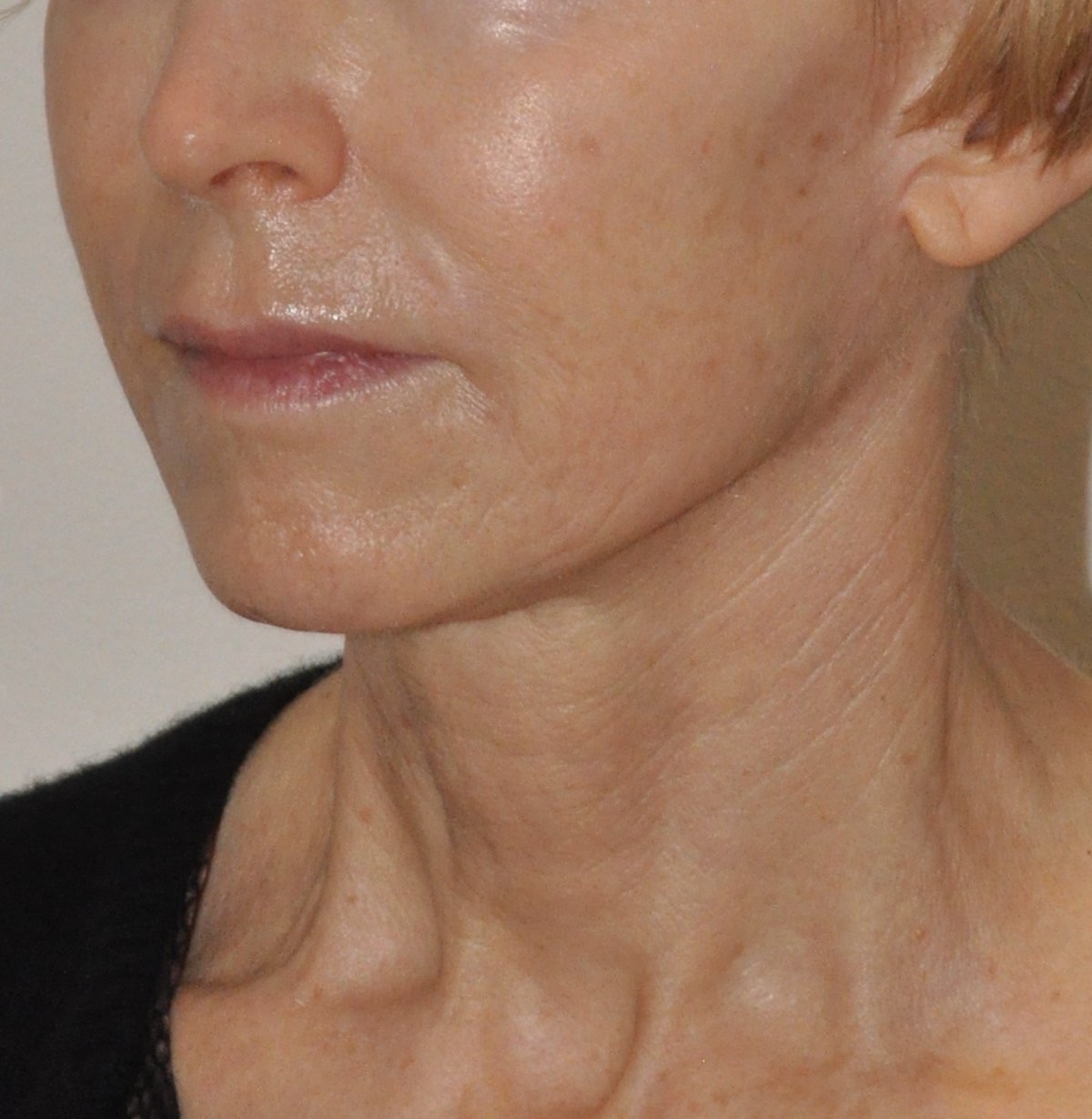 Face & Neck Lift