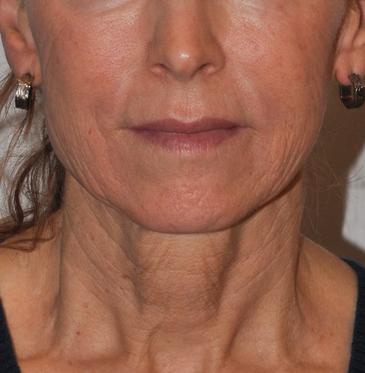 Face & Neck Lift