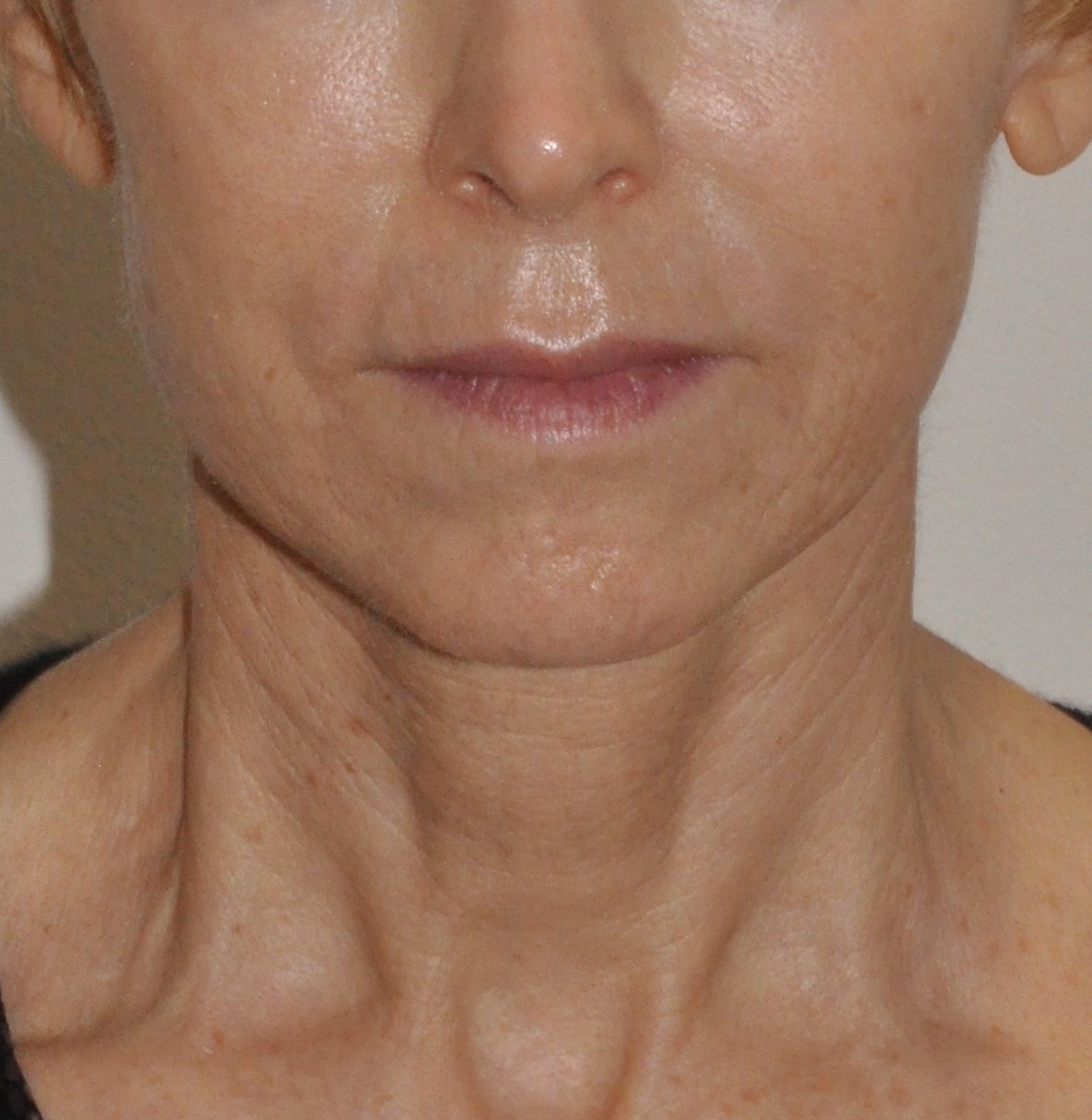 Face & Neck Lift