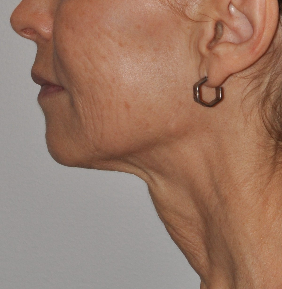 Face & Neck Lift