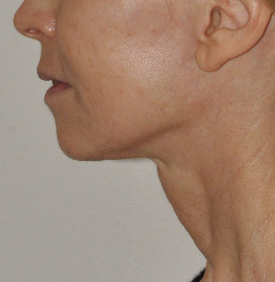 Face & Neck Lift