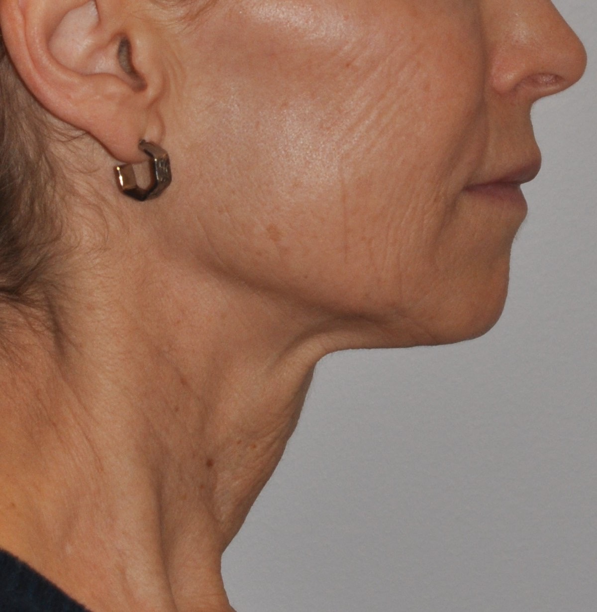 Face & Neck Lift