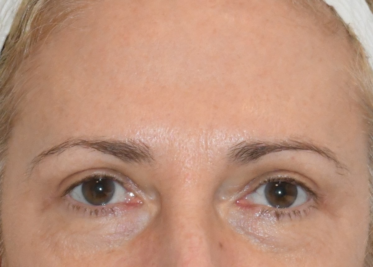 Brow Lift