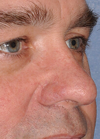 Nose Reconstruction