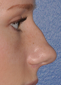 Rhinoplasty