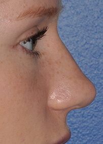 Rhinoplasty