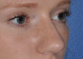 Rhinoplasty