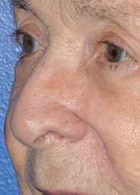 Nose Reconstruction