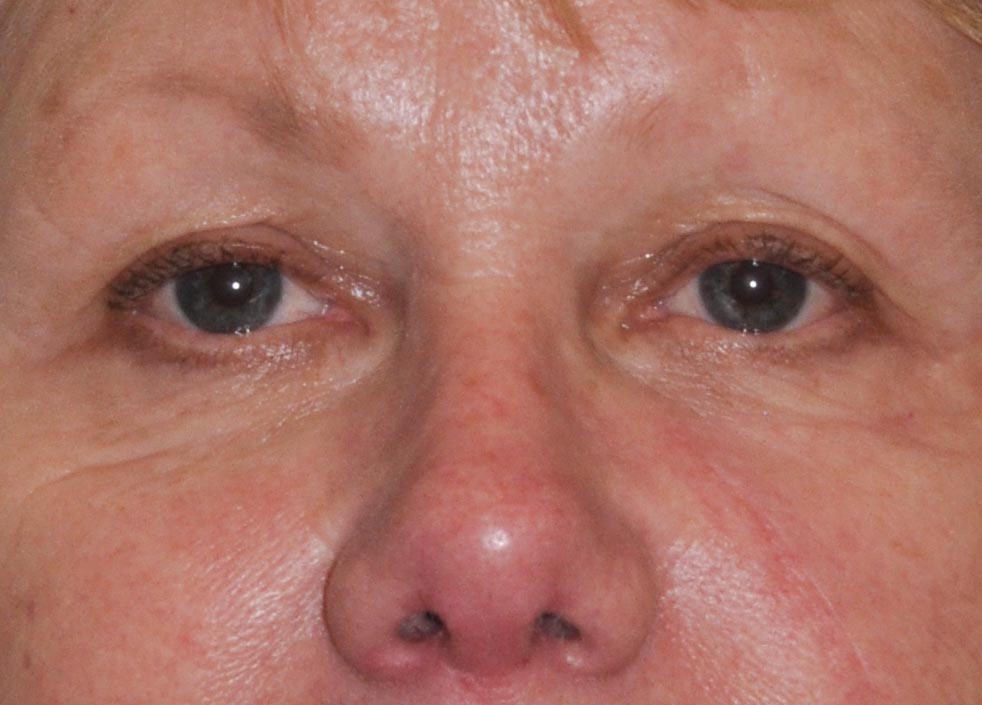 Eyelid & Cheek Reconstruction