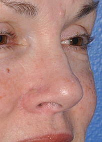 Nose Reconstruction