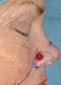 Nose Reconstruction