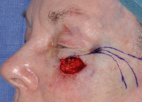 Eyelid & Cheek Reconstruction