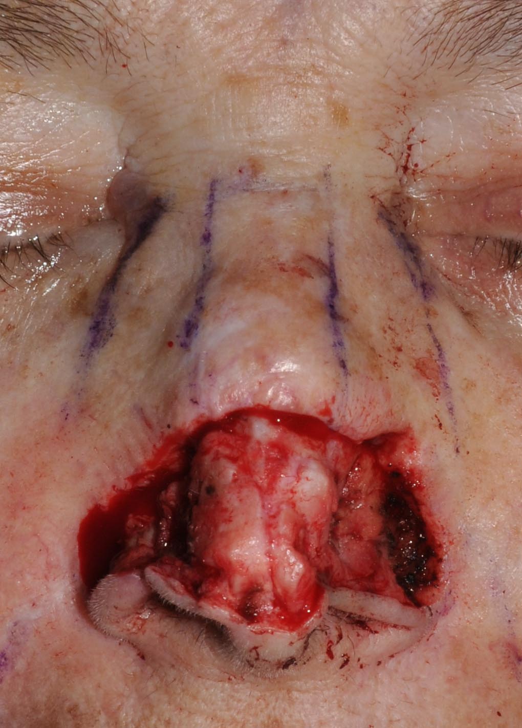 Nose Reconstruction