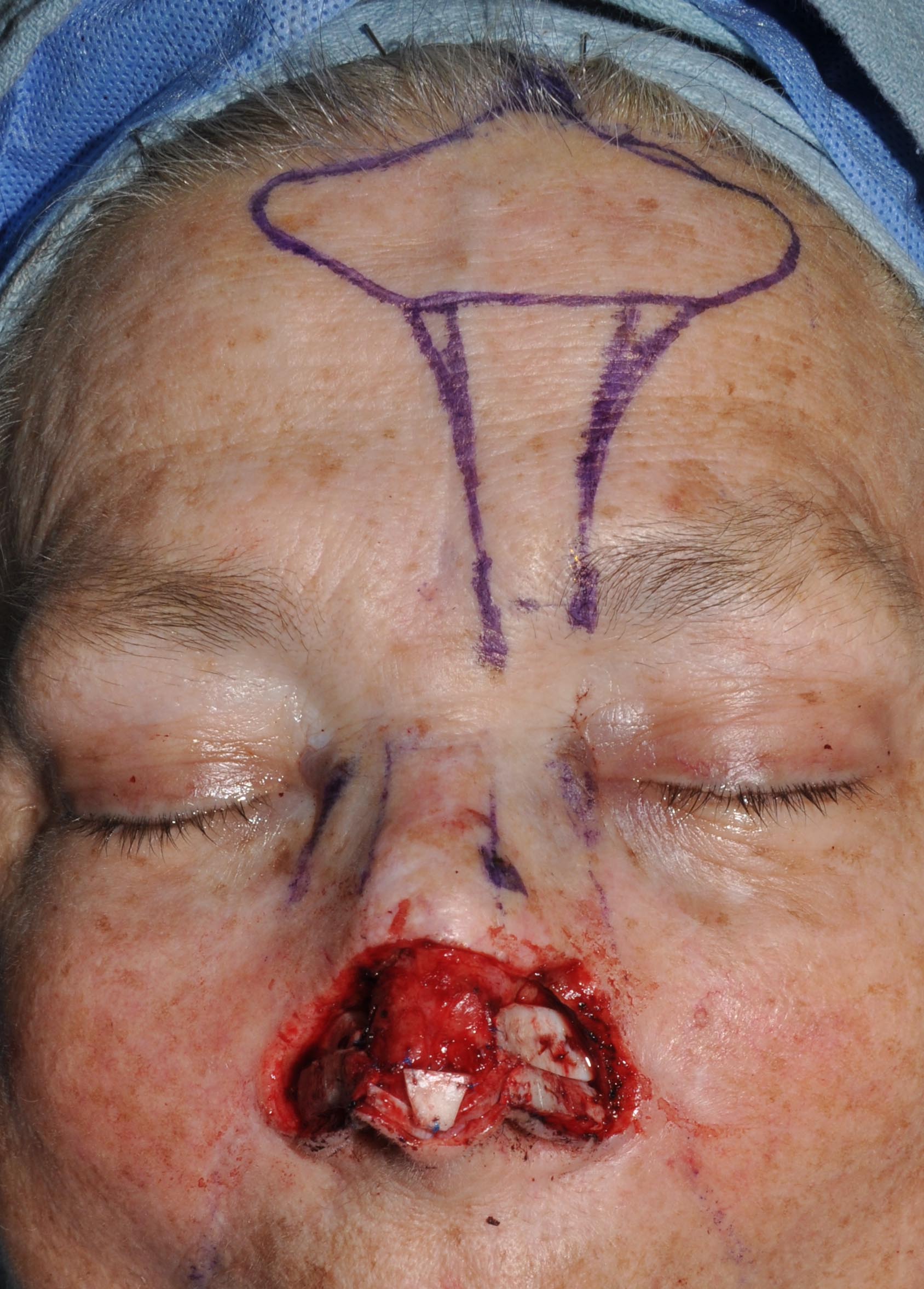 Nose Reconstruction