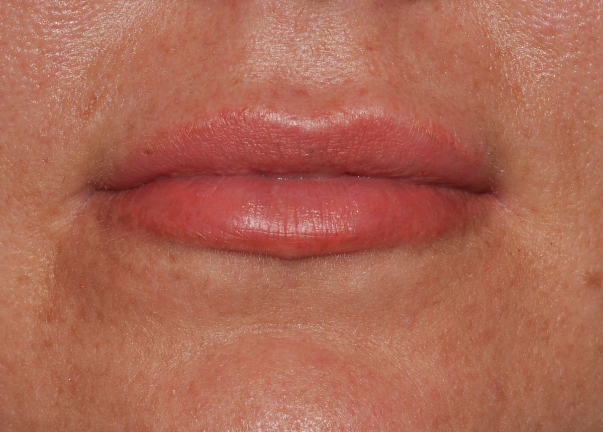 Facial Fillers