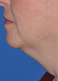 Face & Neck Lift