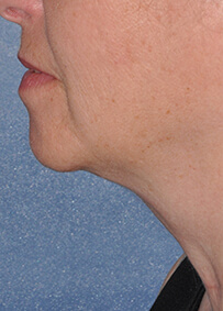 Face & Neck Lift