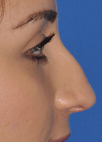 Rhinoplasty