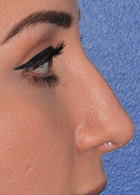 Rhinoplasty