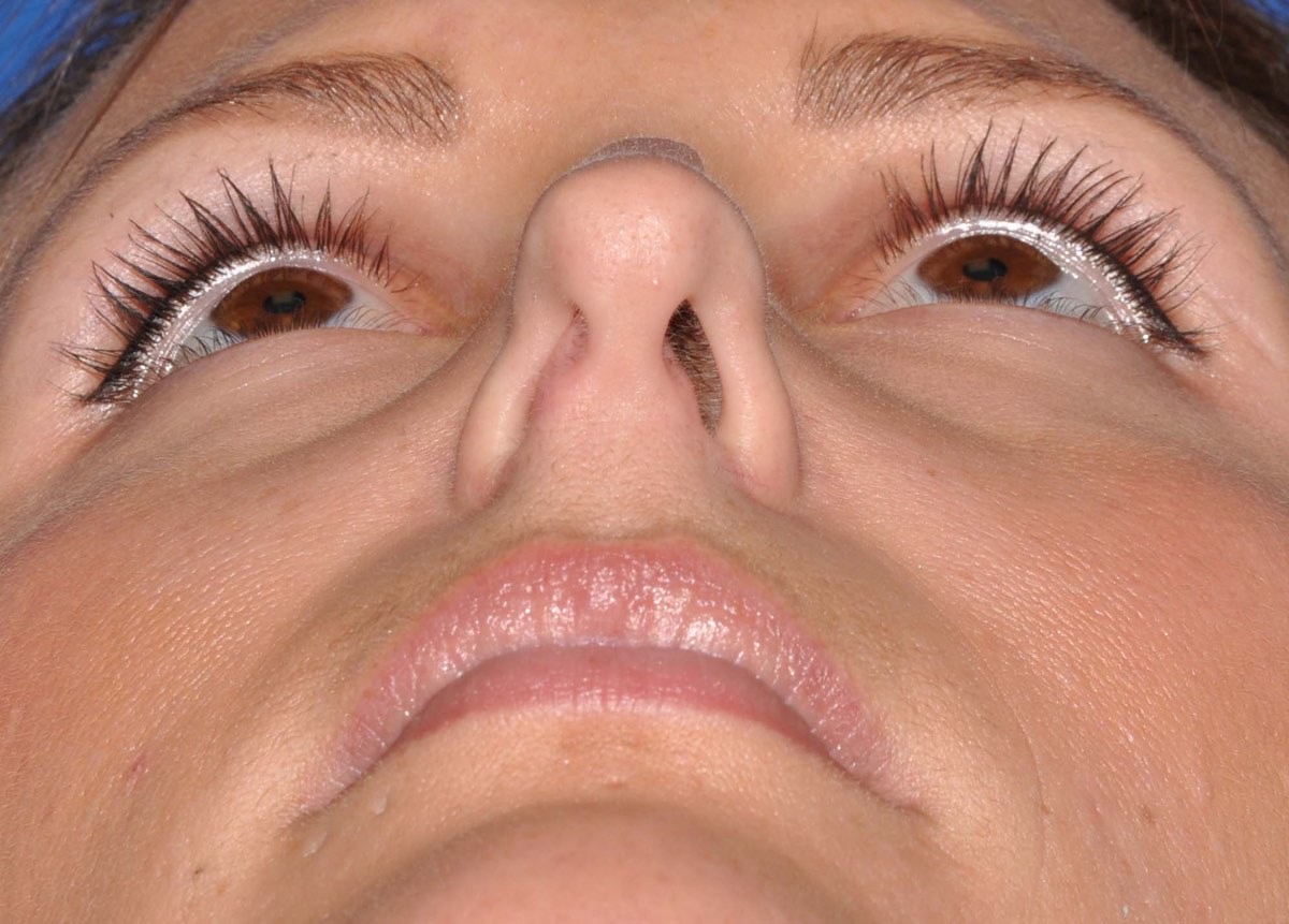 Nasal Surgery for Breathing