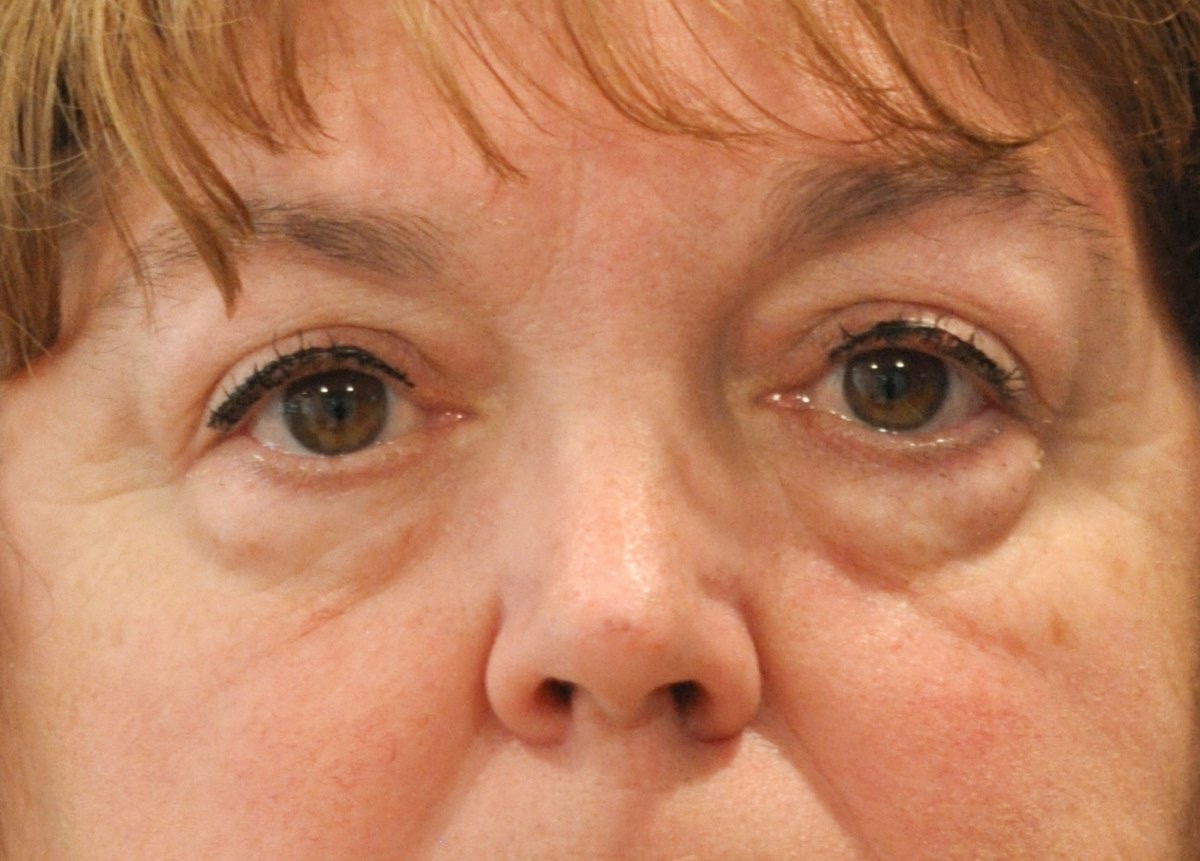 Blepharoplasty (Eyelid Lift)