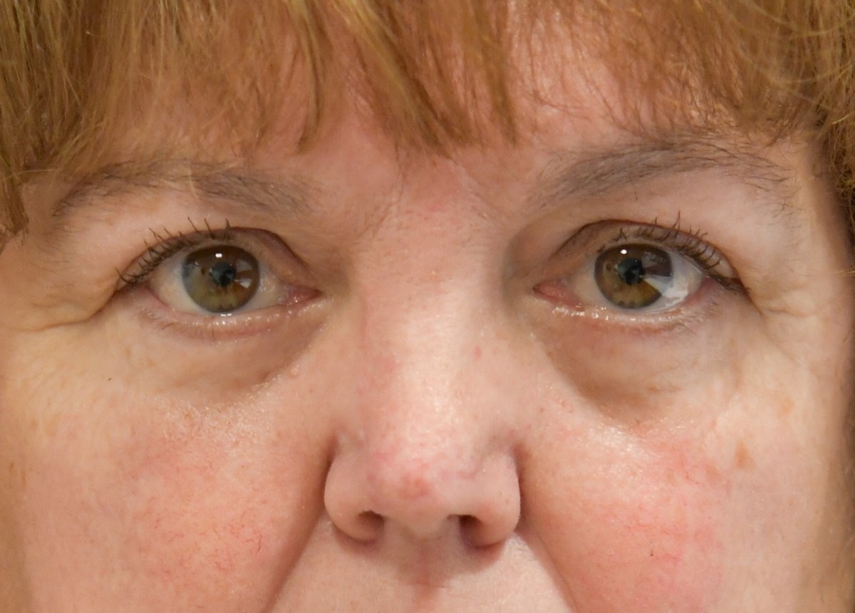 Blepharoplasty (Eyelid Lift)