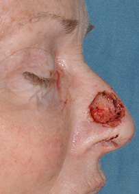 Nose Reconstruction