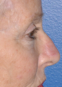 Nose Reconstruction