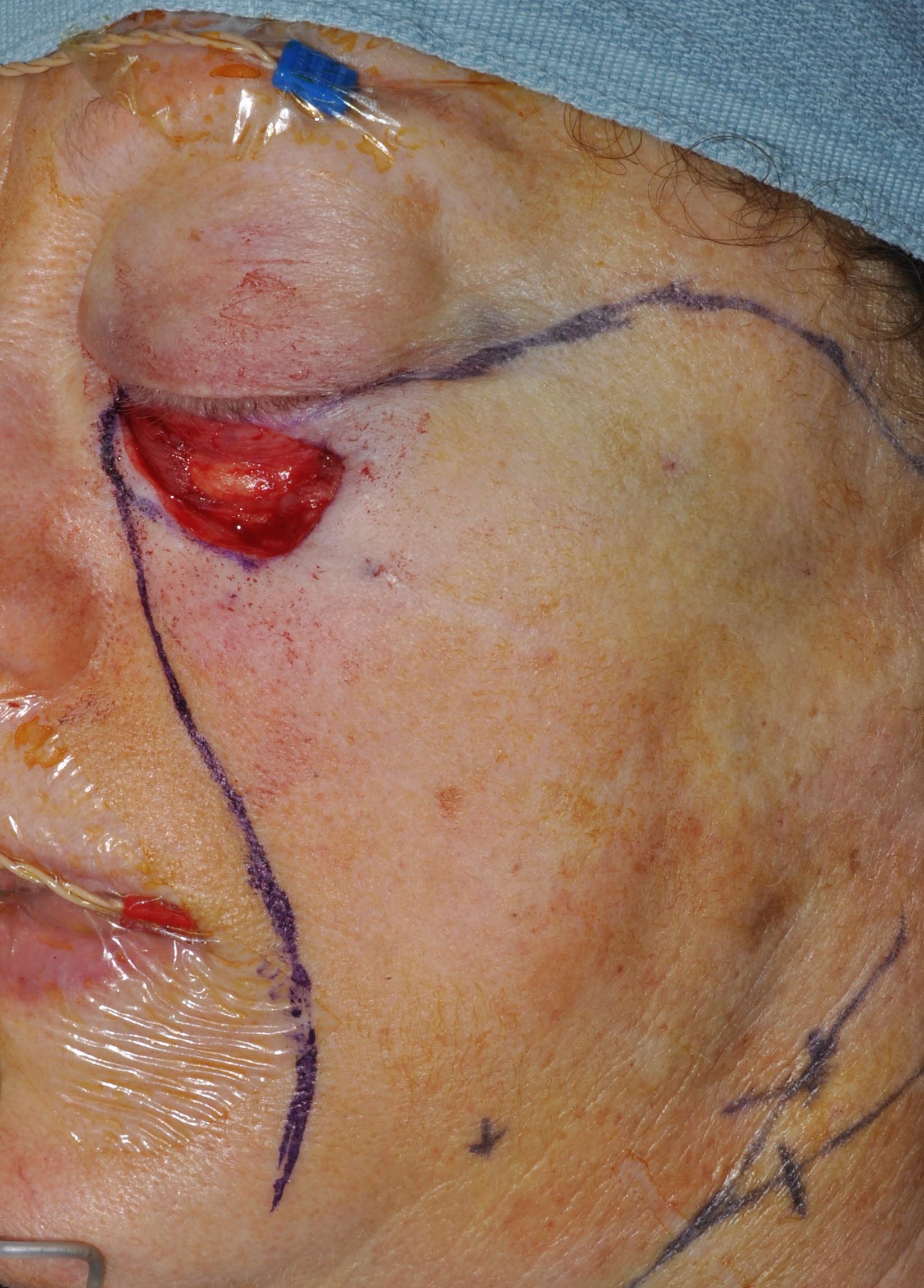 Eyelid & Cheek Reconstruction