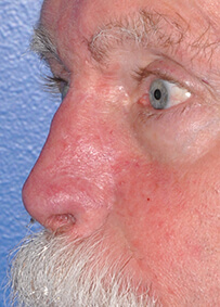 Nose Reconstruction