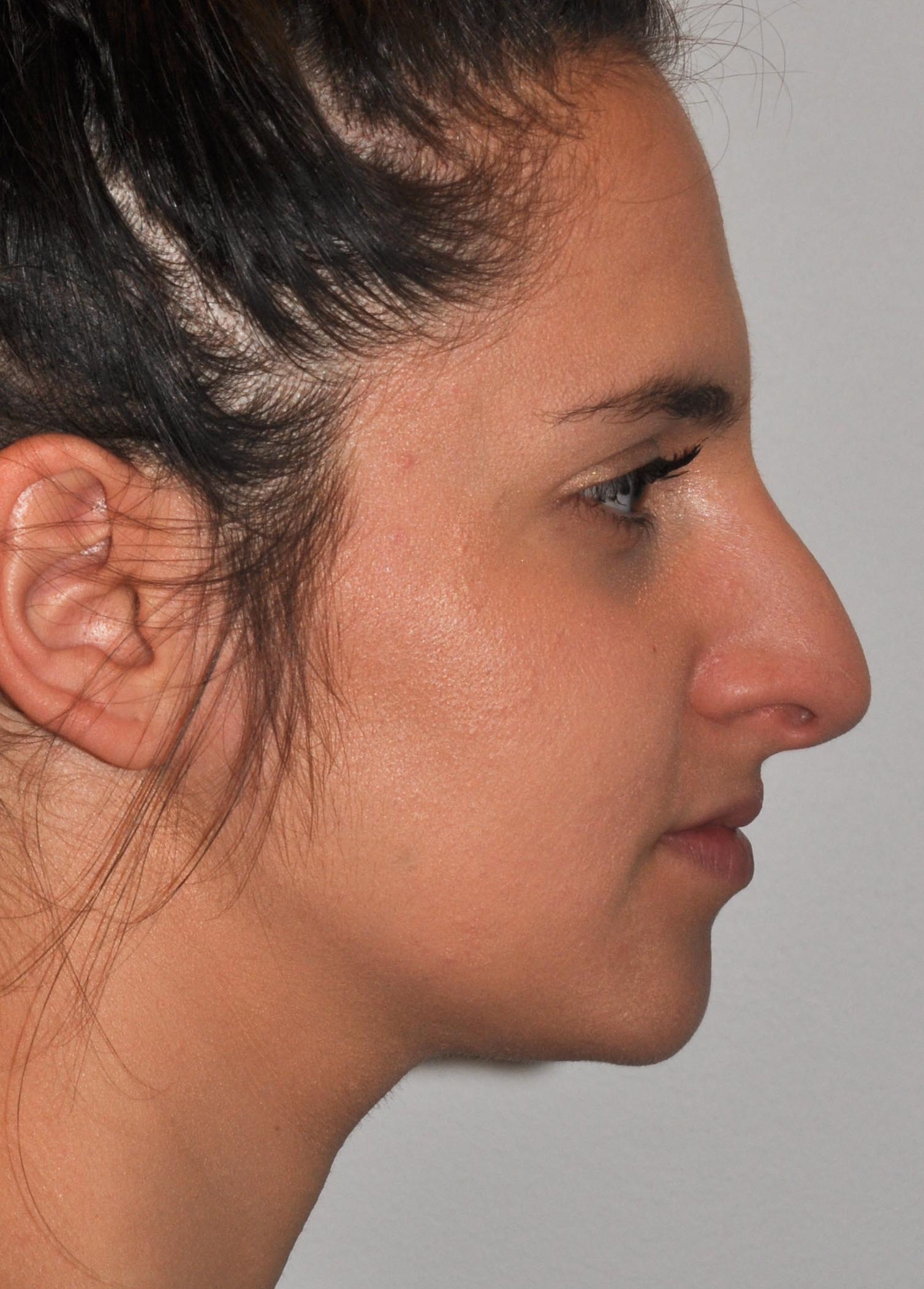 Rhinoplasty