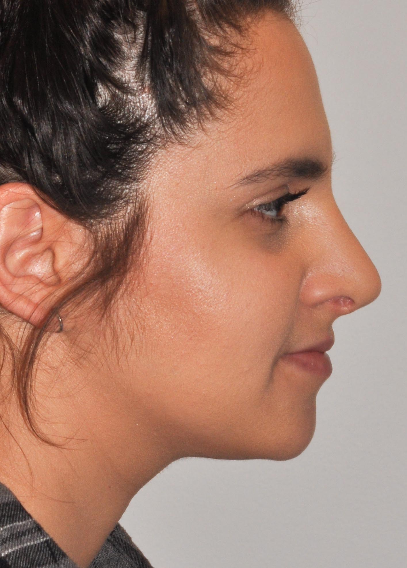 Rhinoplasty