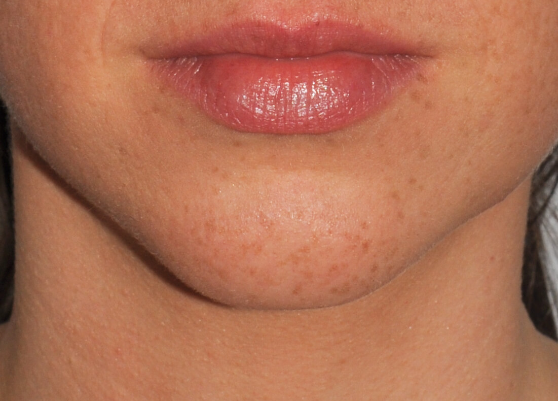 Chin Augmentation