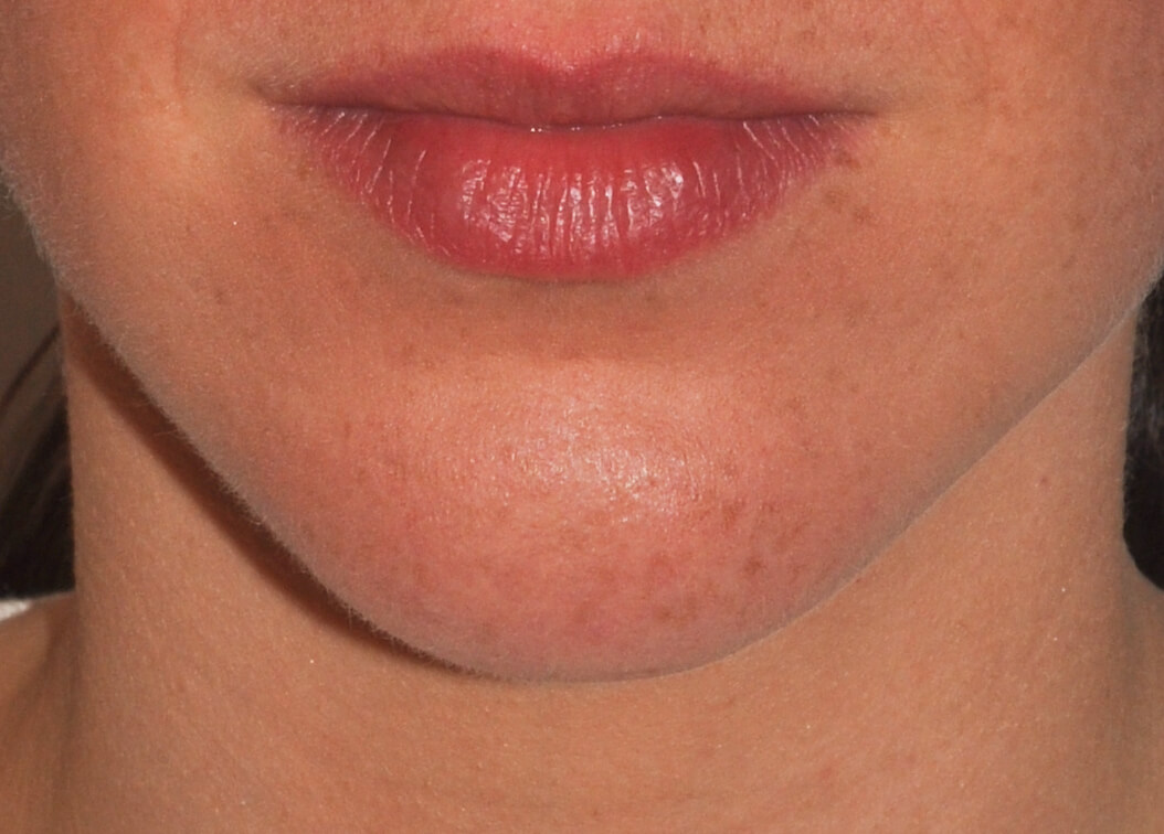 Chin Augmentation