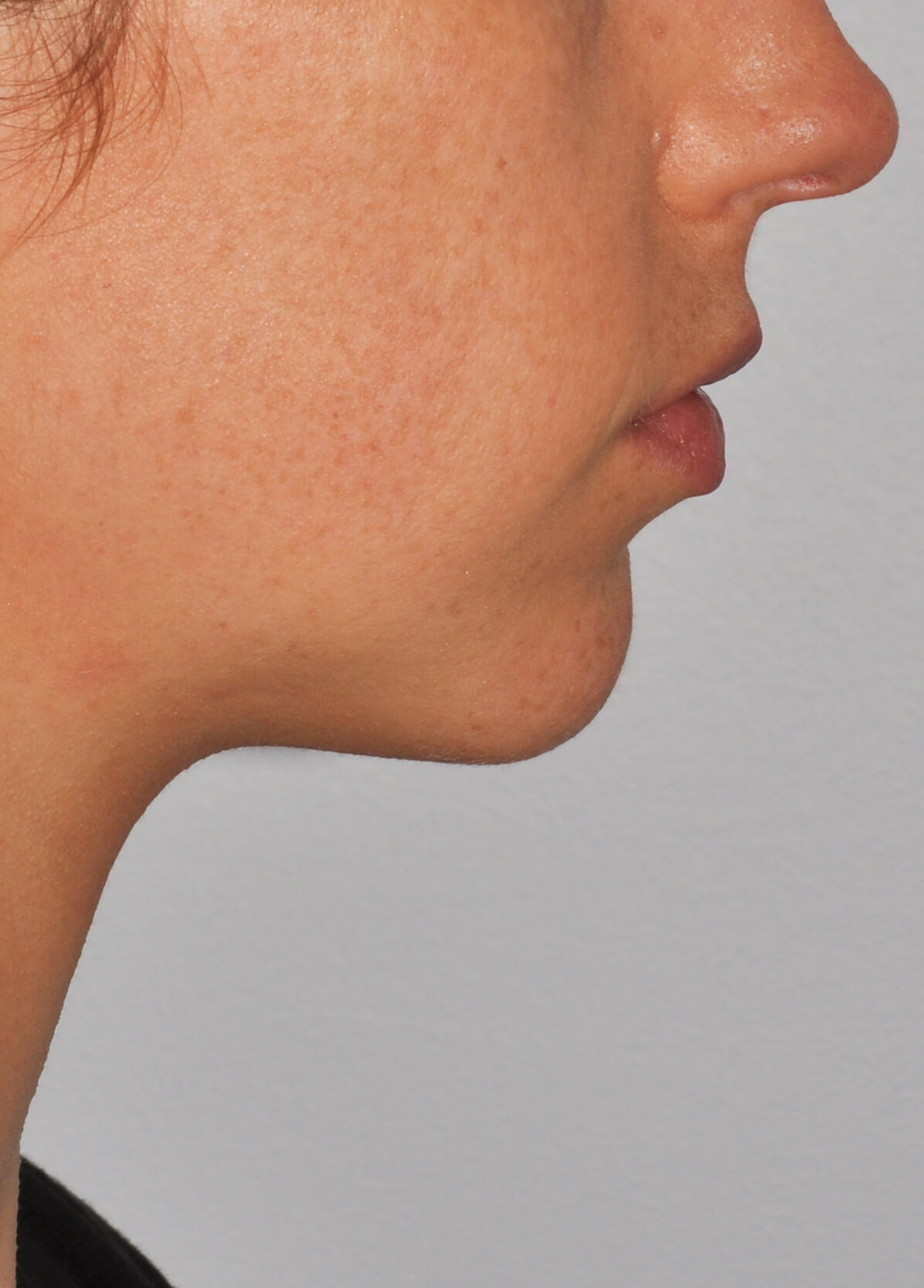 Chin Augmentation