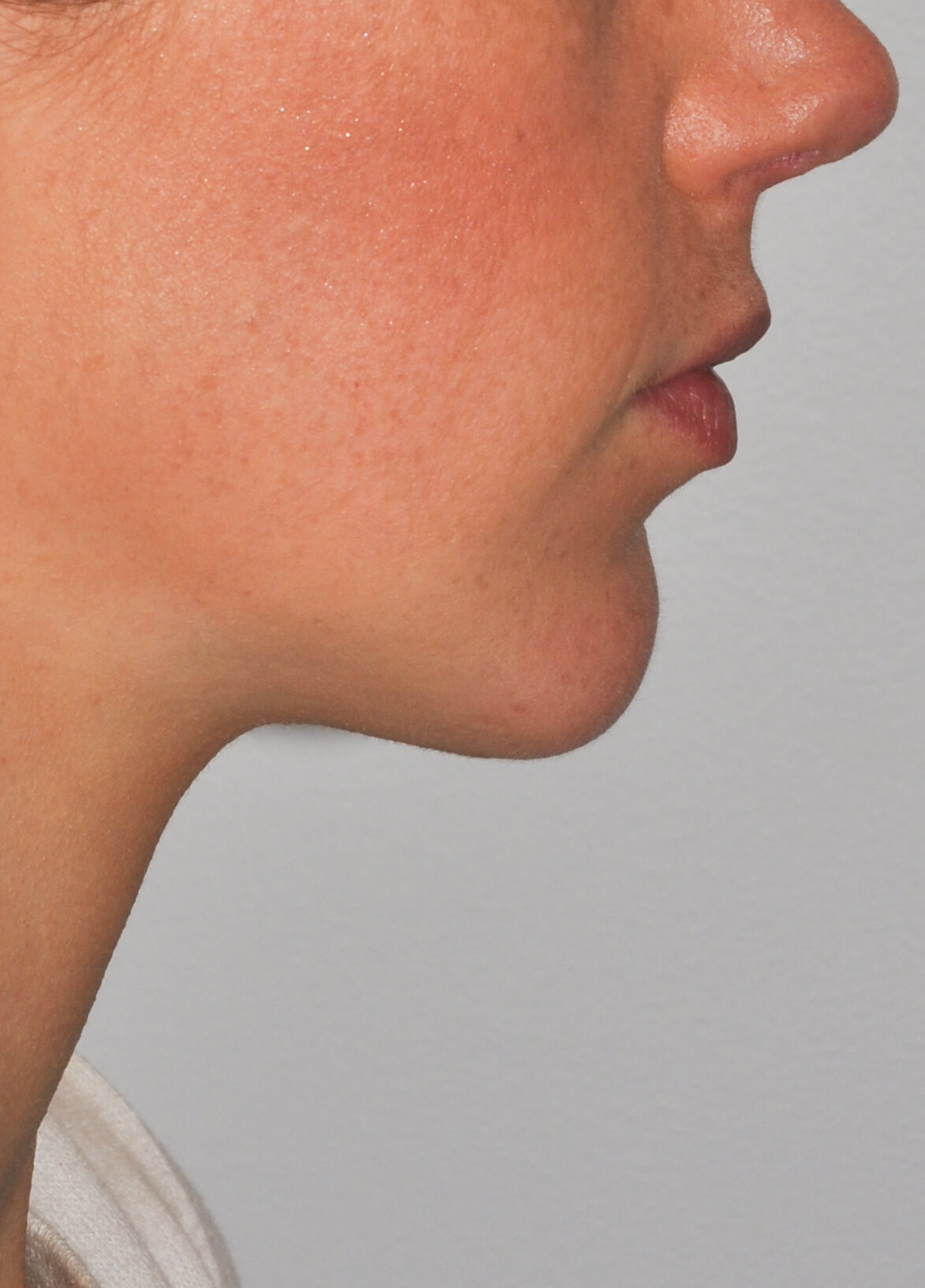 Chin Augmentation