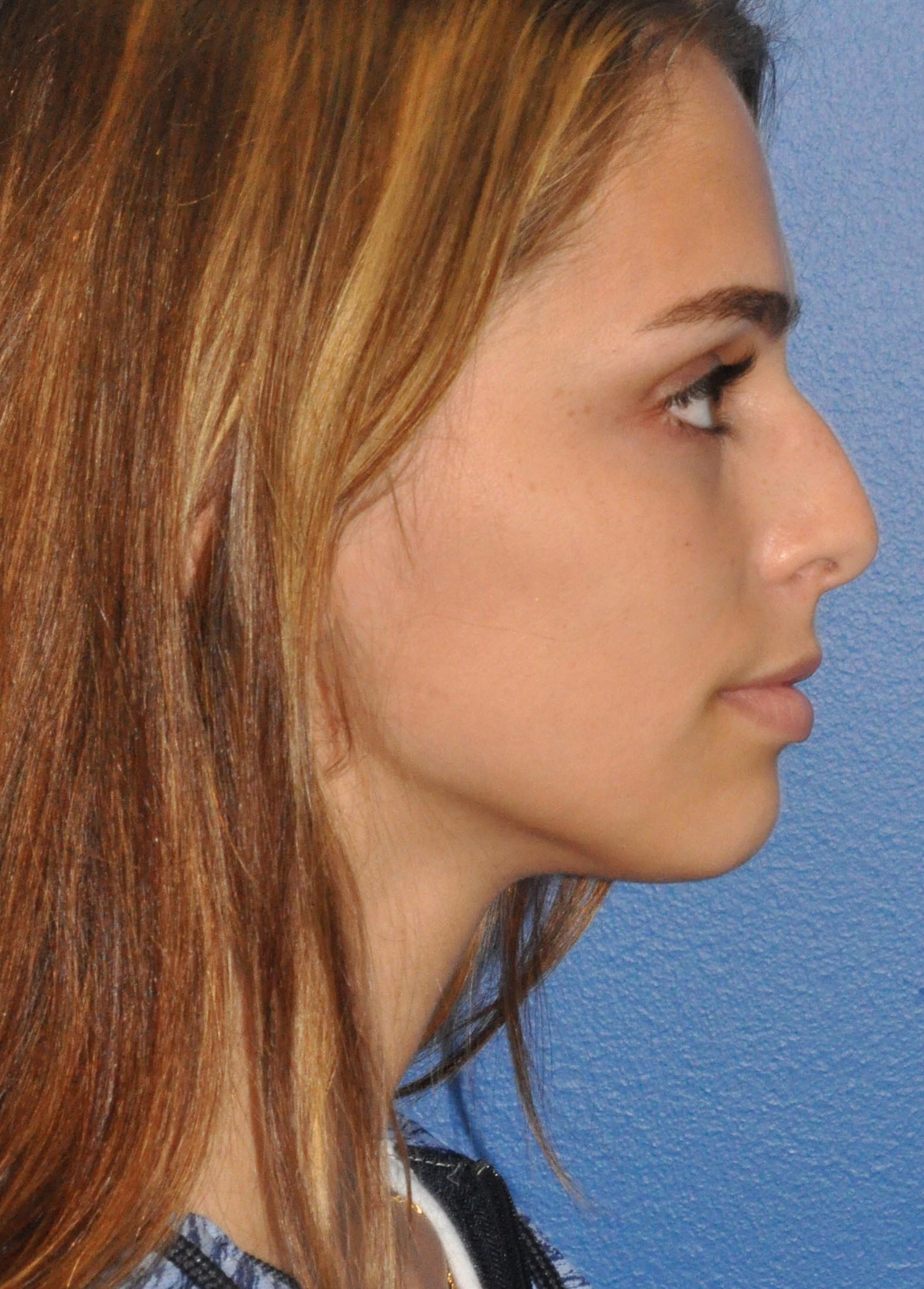 Rhinoplasty