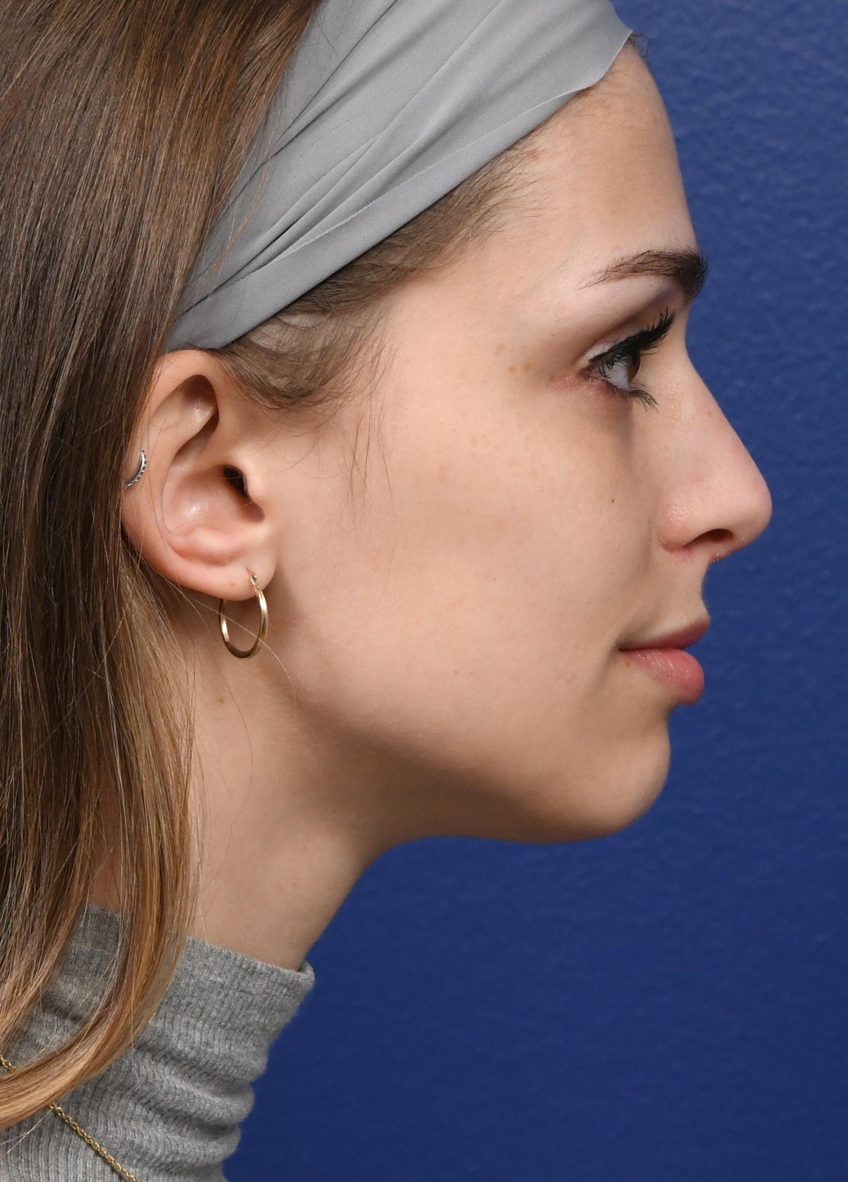 Rhinoplasty