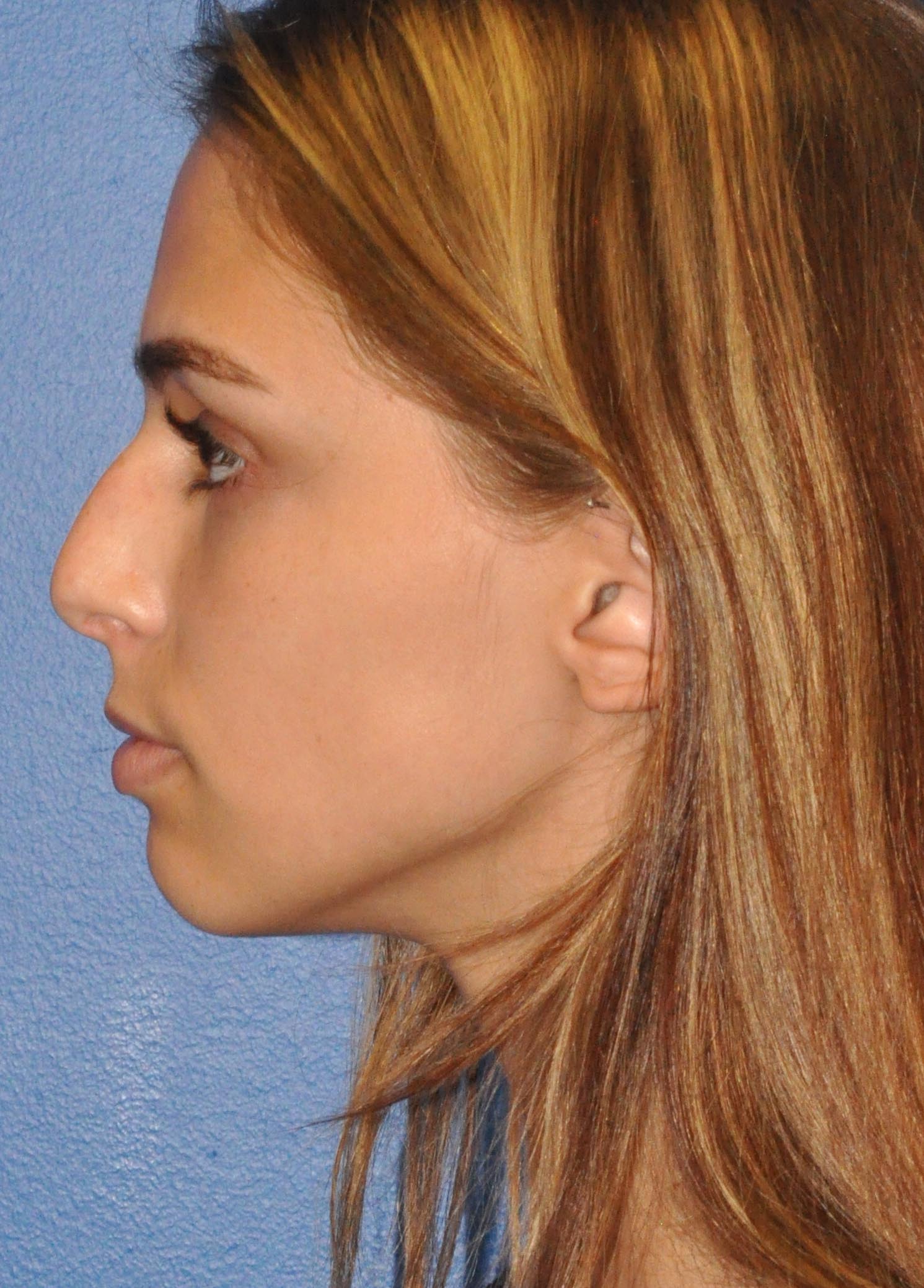 Rhinoplasty