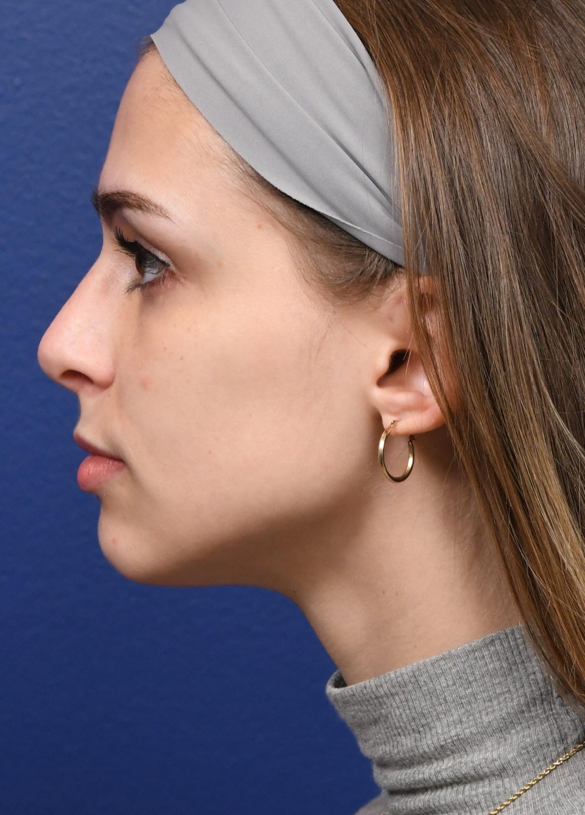 Rhinoplasty