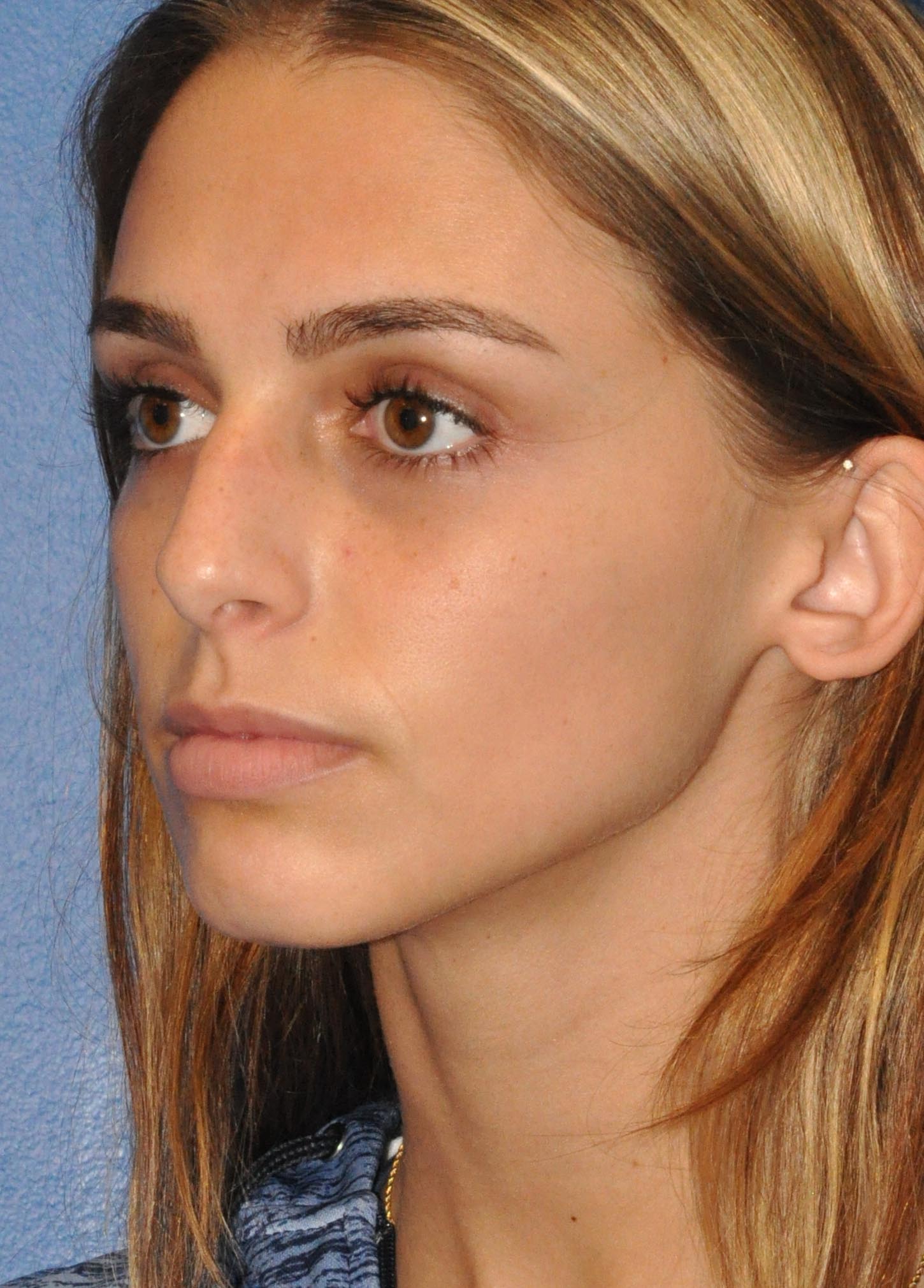 Rhinoplasty